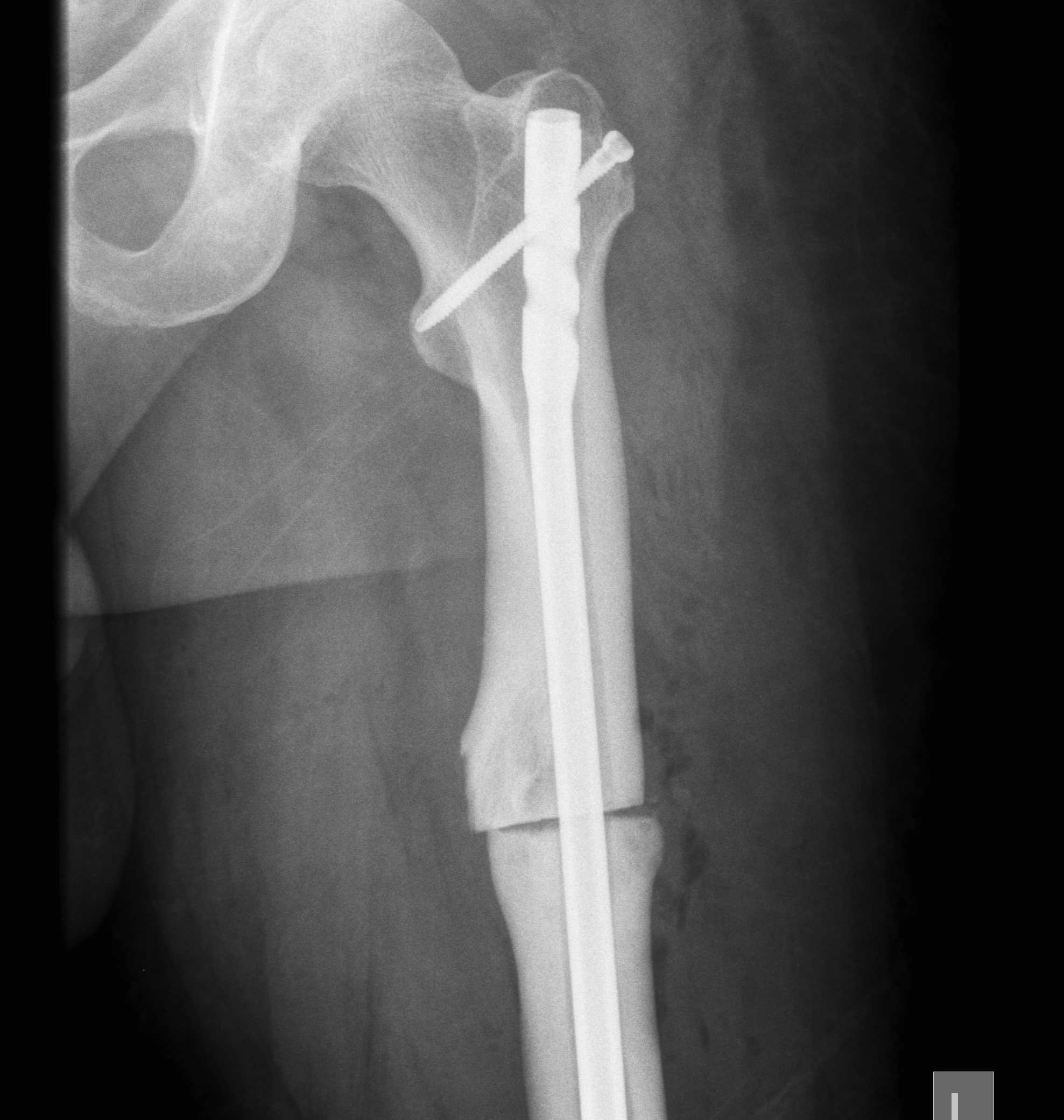 TKR Staged Osteotomy Post op correction